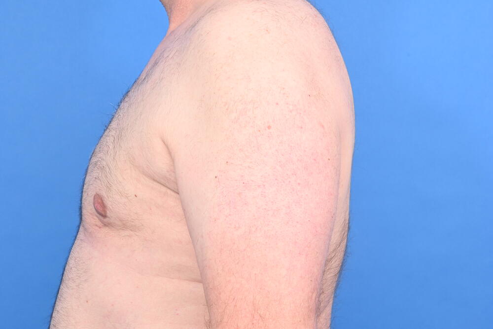 Gynecomastia Surgery Before & After Image