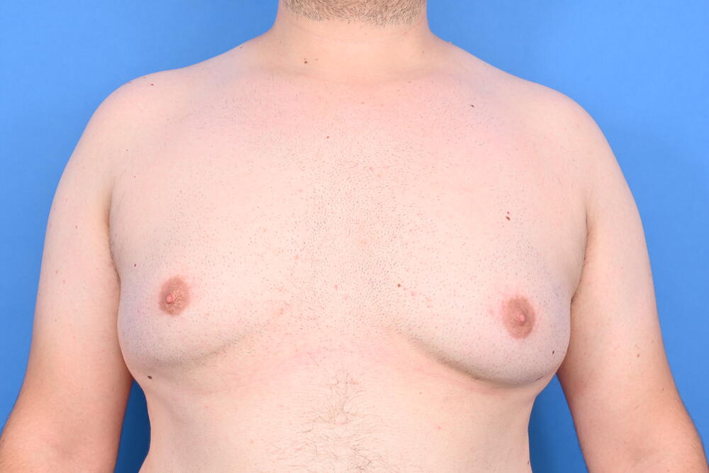 Gynecomastia Surgery Before & After Image