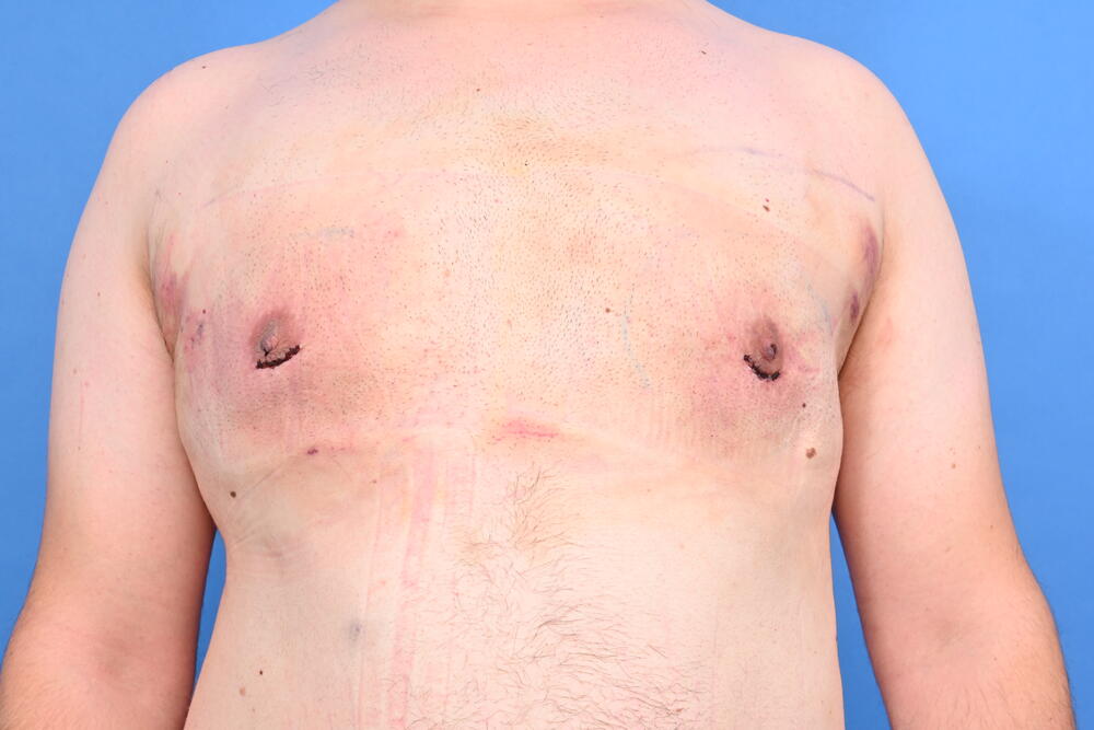 Gynecomastia Surgery Before & After Image