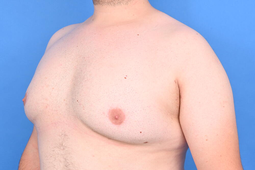 Gynecomastia Surgery Before & After Image