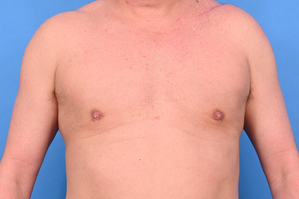 Gynecomastia Surgery Before & After Image