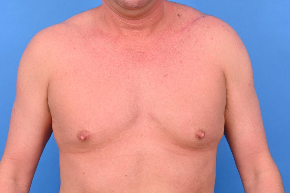 Gynecomastia Surgery Before & After Image