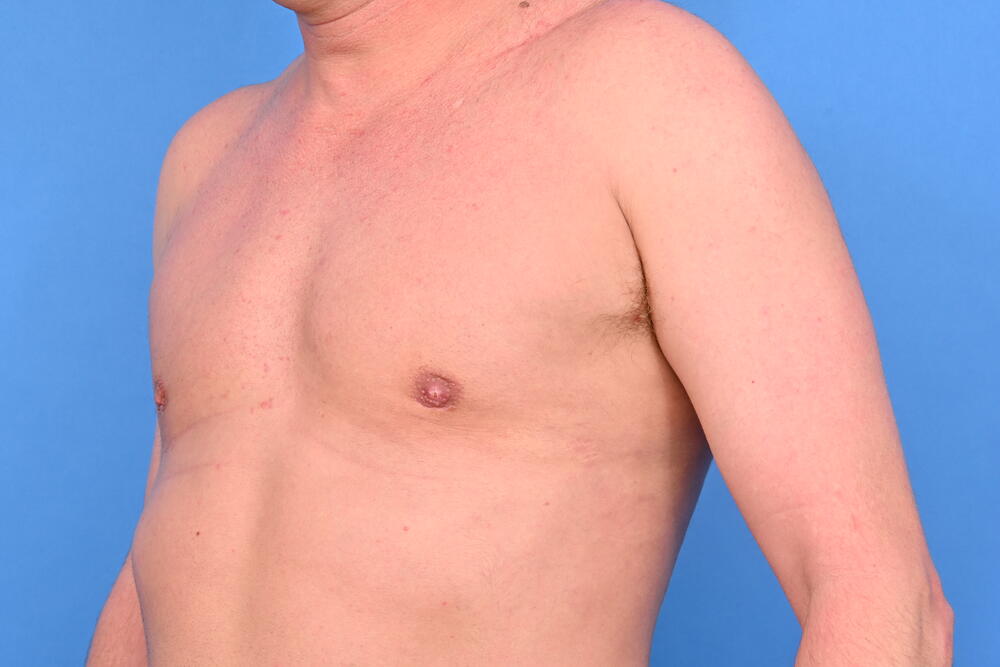 Gynecomastia Surgery Before & After Image