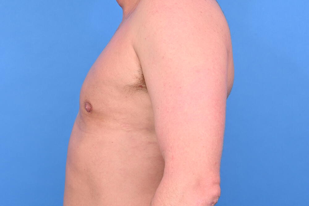 Gynecomastia Surgery Before & After Image