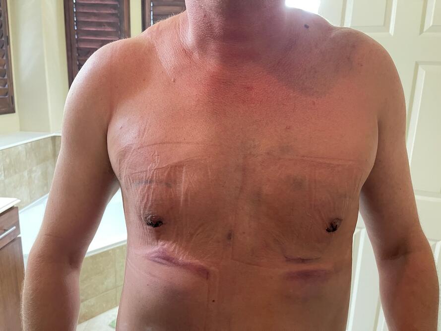 Gynecomastia Surgery Before & After Image