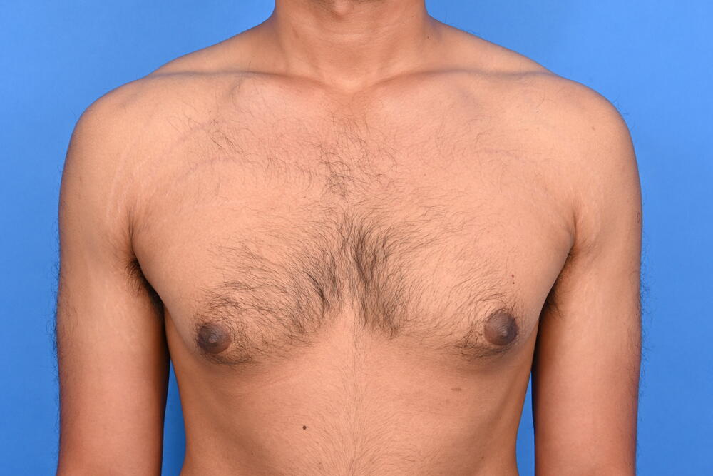 Gynecomastia Surgery Before & After Image