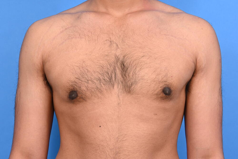 Gynecomastia Surgery Before & After Image