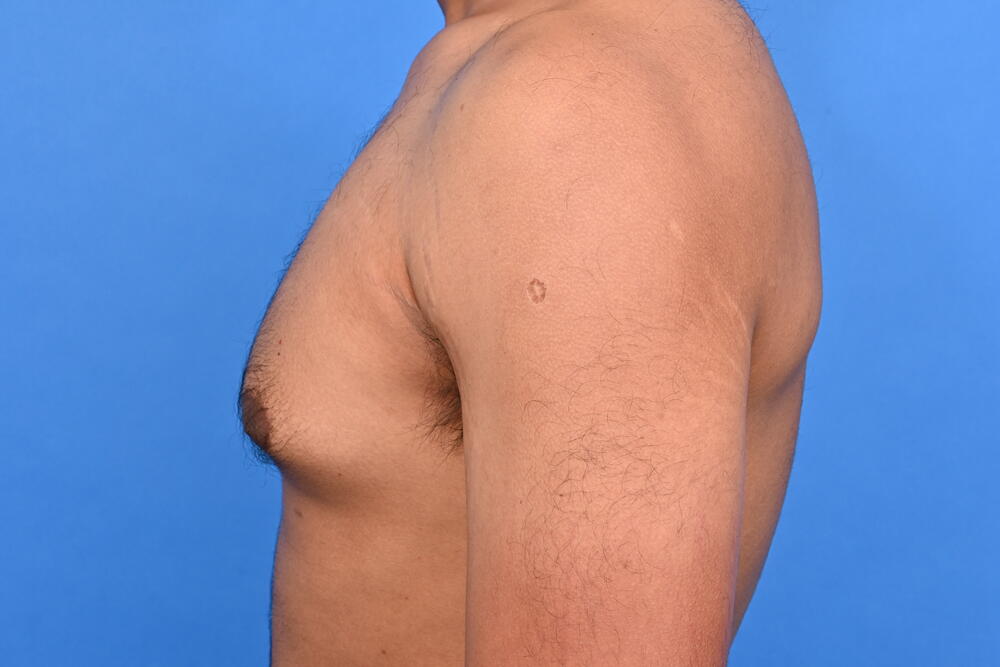 Gynecomastia Surgery Before & After Image