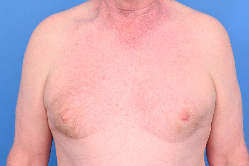 Gynecomastia Surgery Before & After Image