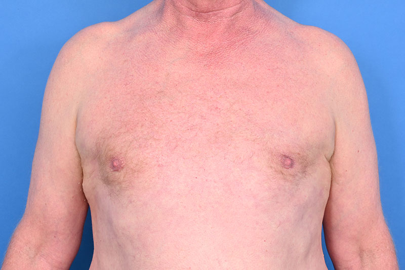 Gynecomastia Surgery Before & After Image