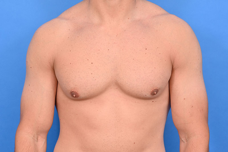 Gynecomastia Surgery Before & After Image