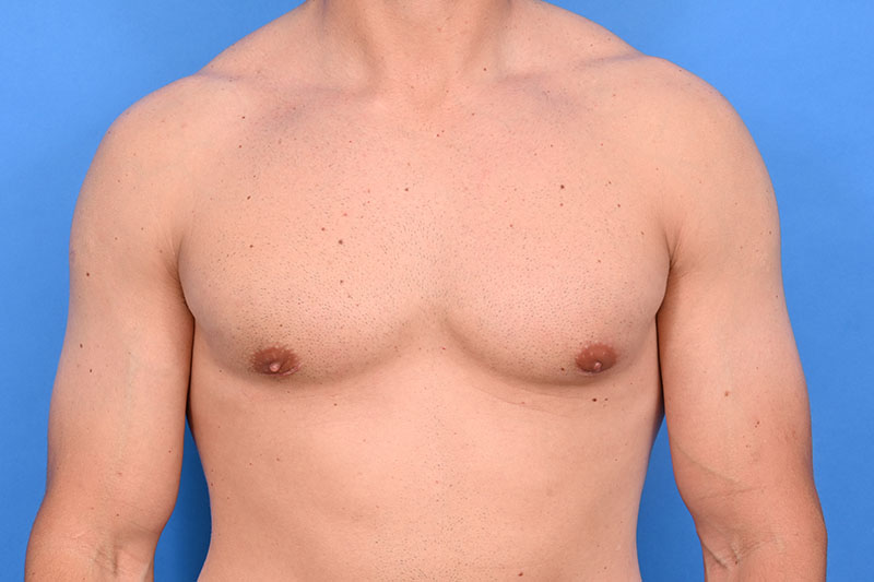 Gynecomastia Surgery Before & After Image
