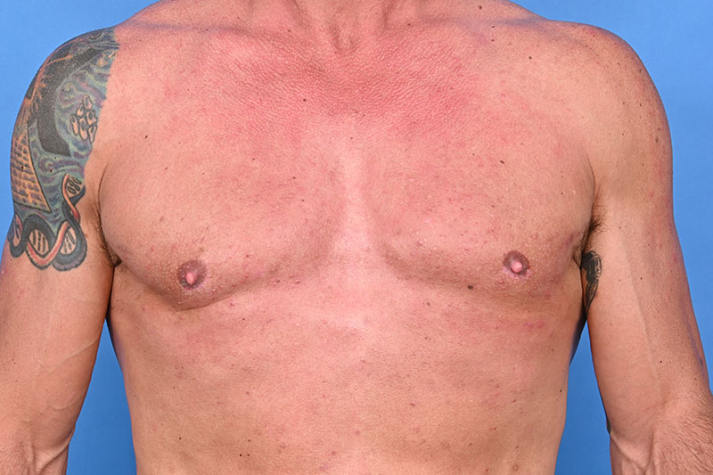 Gynecomastia Surgery Before & After Image