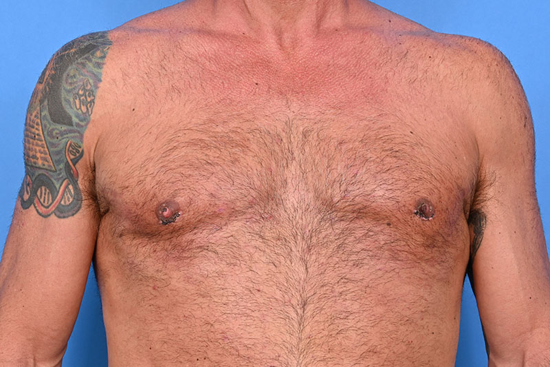 Gynecomastia Surgery Before & After Image