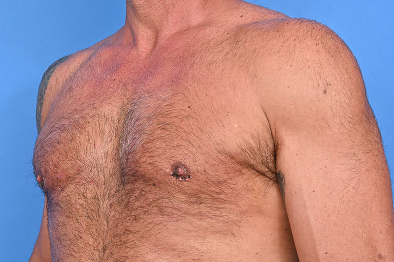 Gynecomastia Surgery Before & After Image