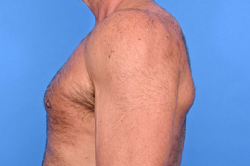 Gynecomastia Surgery Before & After Image