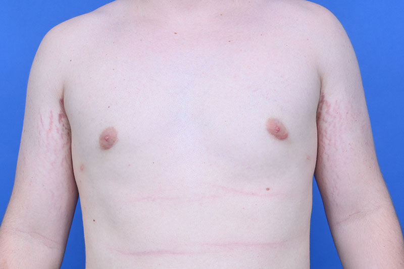 Gynecomastia Surgery Before & After Image
