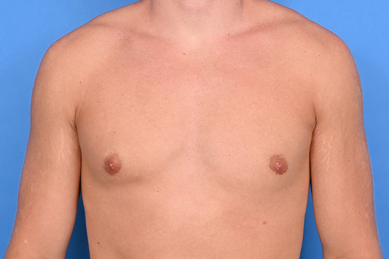 Gynecomastia Surgery Before & After Image