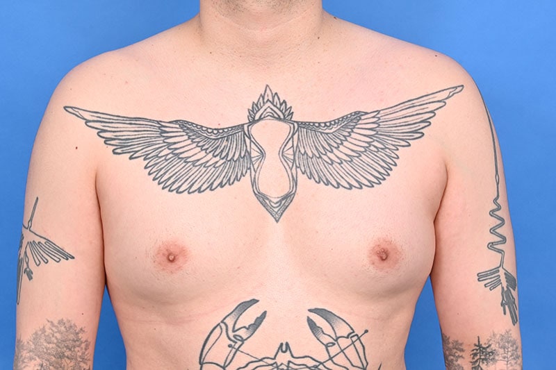 Gynecomastia Surgery Before & After Image