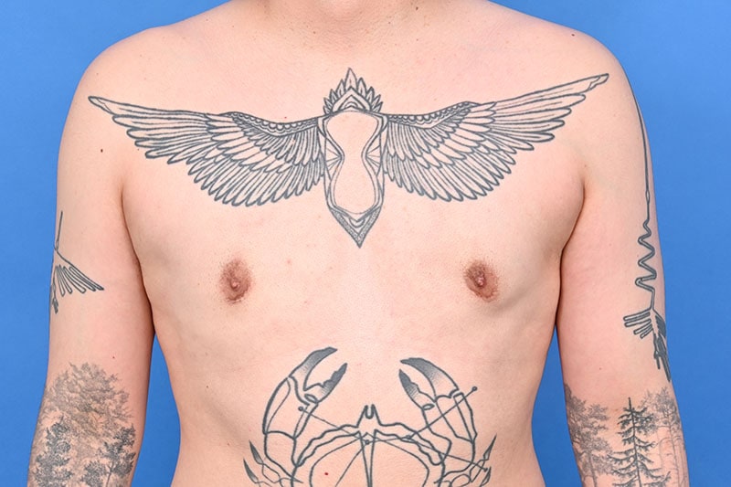 Gynecomastia Surgery Before & After Image