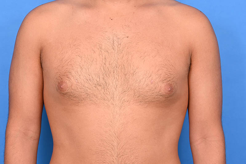 Gynecomastia Surgery Before & After Image