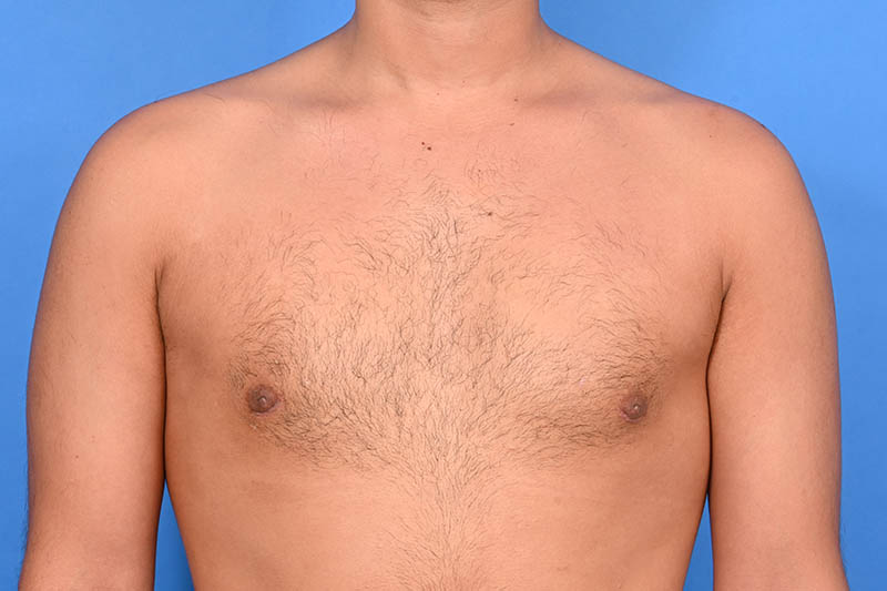 Gynecomastia Surgery Before & After Image