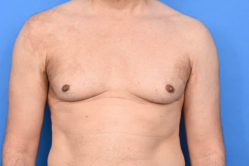 Gynecomastia Surgery Before & After Image