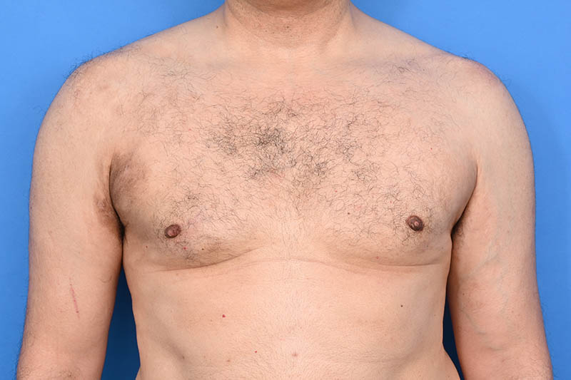 Gynecomastia Surgery Before & After Image