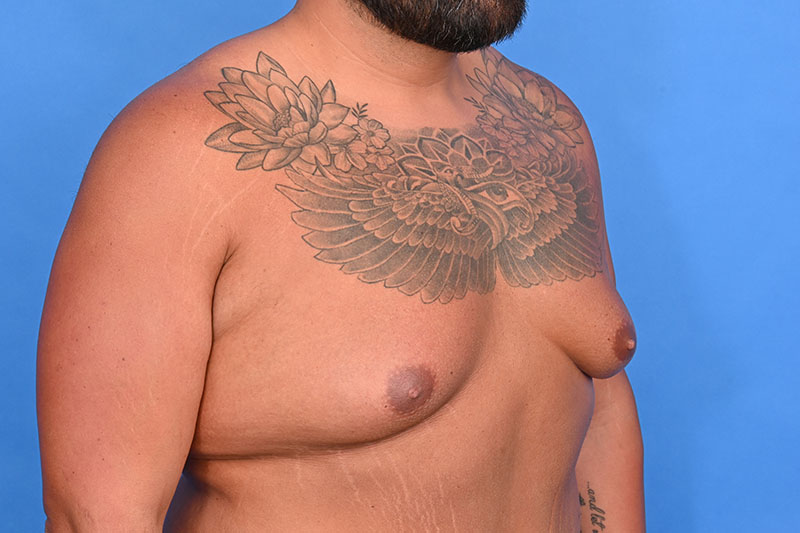 Gynecomastia Surgery Before & After Image