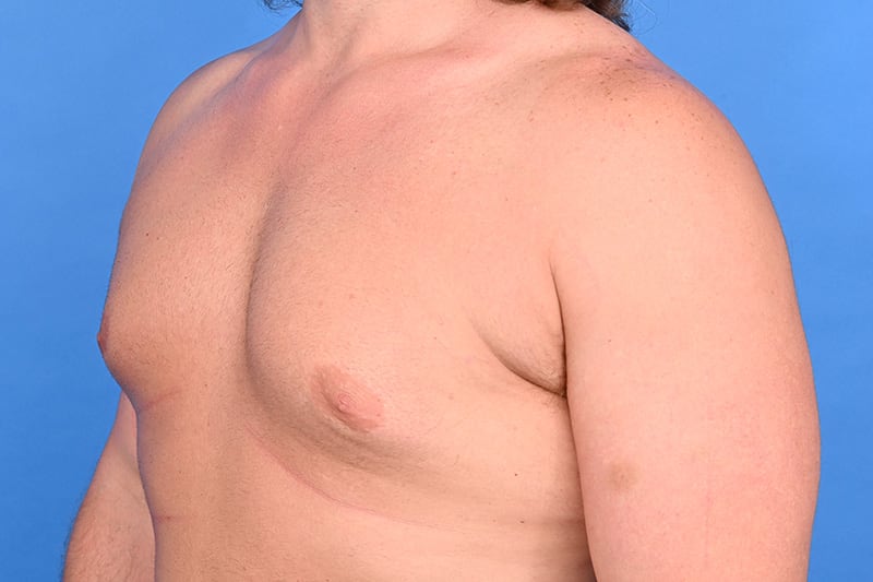 Gynecomastia Surgery Before & After Image