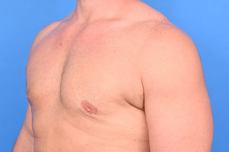 Gynecomastia Surgery Before & After Image