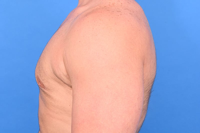 Gynecomastia Surgery Before & After Image