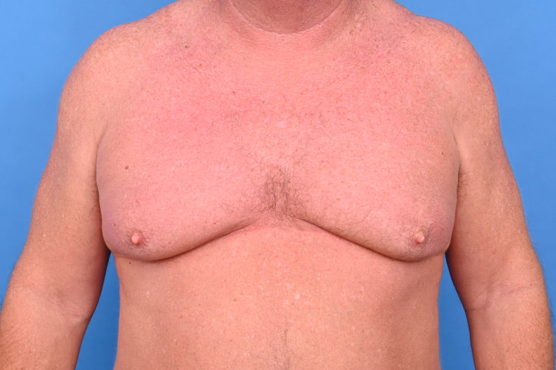 Gynecomastia Surgery Before & After Image