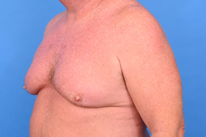 Gynecomastia Surgery Before & After Image