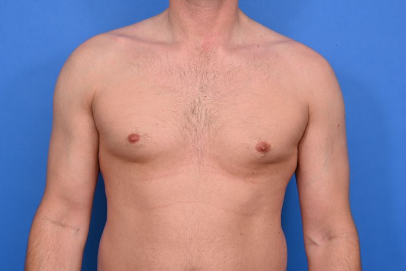 Gynecomastia Surgery Before & After Image