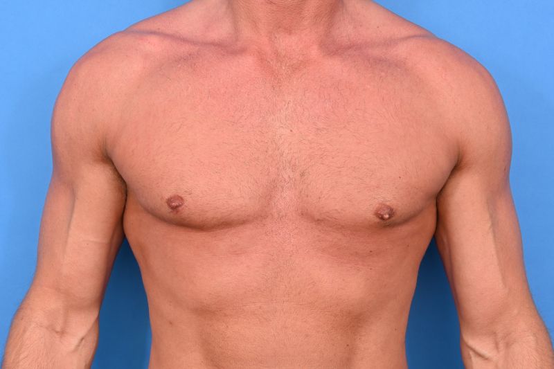Gynecomastia Surgery Before & After Image