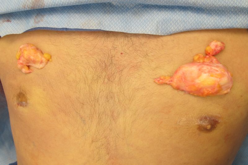 Gynecomastia Surgery Before & After Image