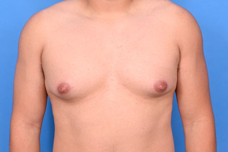 Gynecomastia Surgery Before & After Image