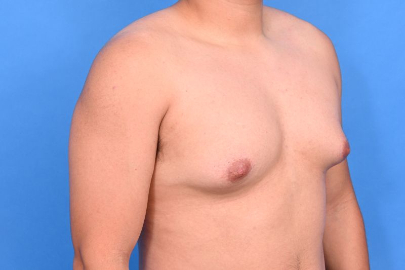 Gynecomastia Surgery Before & After Image