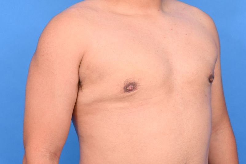 Gynecomastia Surgery Before & After Image