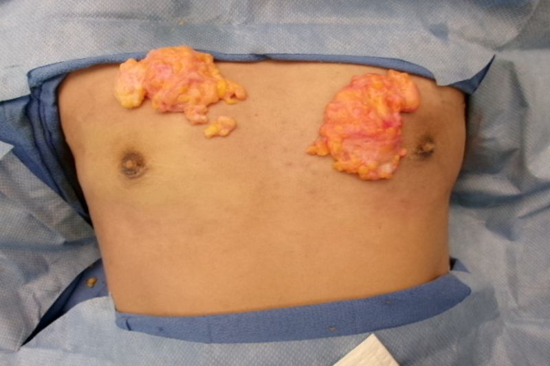 Gynecomastia Surgery Before & After Image