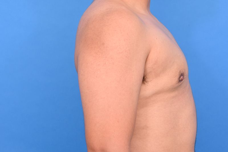 Gynecomastia Surgery Before & After Image