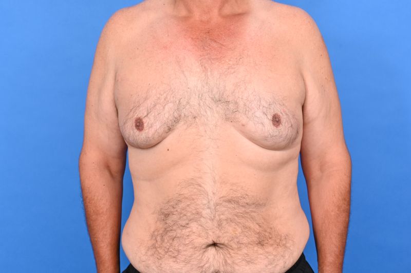 Gynecomastia Surgery Before & After Image