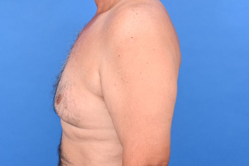 Gynecomastia Surgery Before & After Image