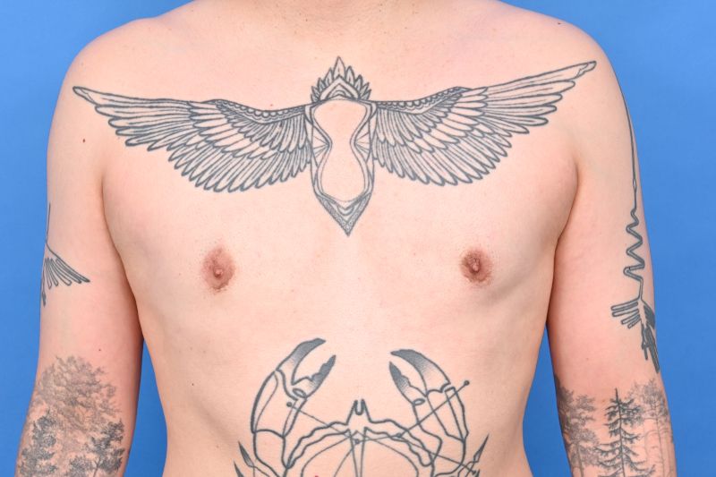 Gynecomastia Surgery Before & After Image