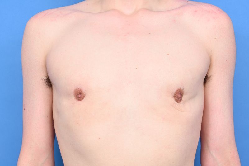 Gynecomastia Surgery Before & After Image