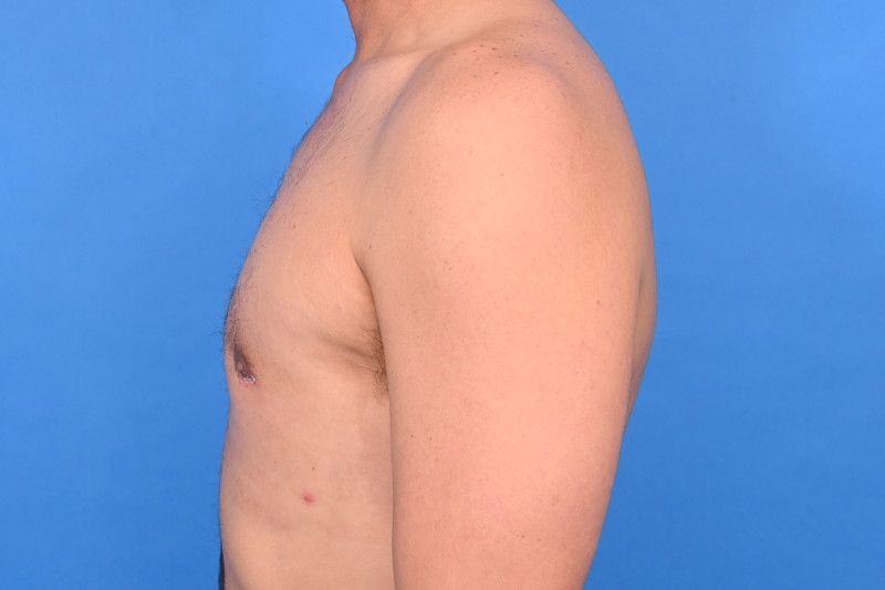 Gynecomastia Surgery Before & After Image