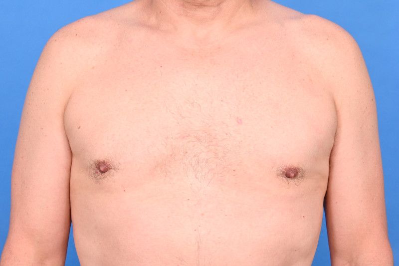 Gynecomastia Surgery Before & After Image