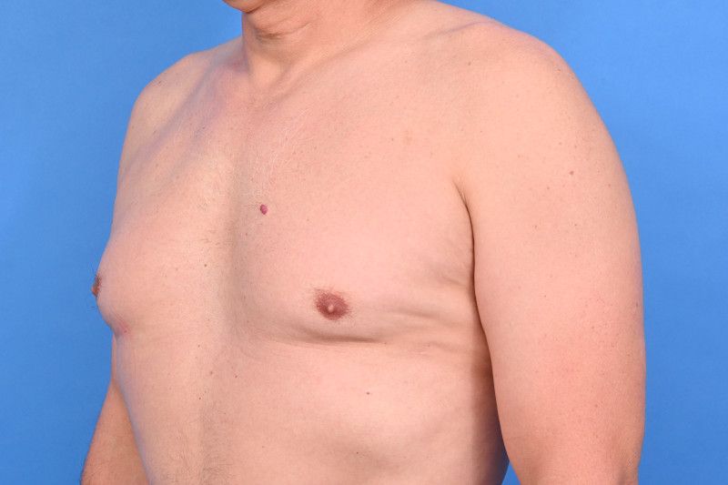 Gynecomastia Surgery Before & After Image