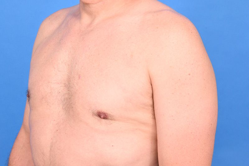 Gynecomastia Surgery Before & After Image